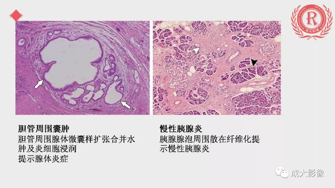 影像PPT - 【PPT】“对应性胆系胰腺疾病”的影像表现-15 影像PPT - 【PPT】“对应性胆系胰腺疾病”的影像表现-15