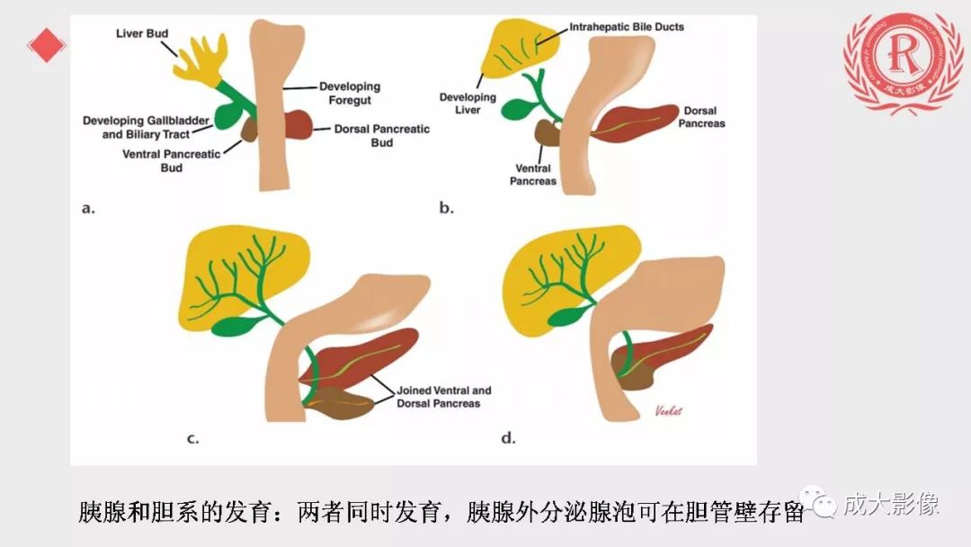 影像PPT - 【PPT】“对应性胆系胰腺疾病”的影像表现-6 影像PPT - 【PPT】“对应性胆系胰腺疾病”的影像表现-6