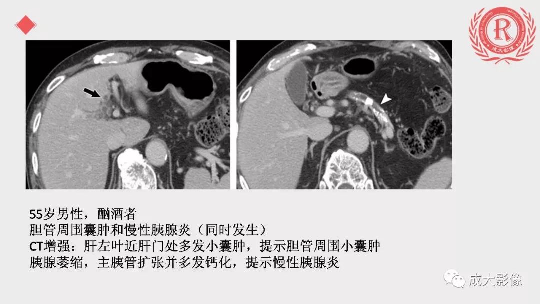 影像PPT - 【PPT】“对应性胆系胰腺疾病”的影像表现-16 影像PPT - 【PPT】“对应性胆系胰腺疾病”的影像表现-16