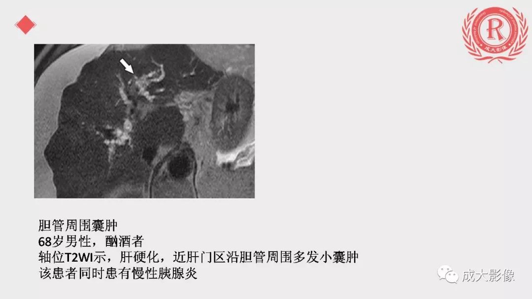 影像PPT - 【PPT】“对应性胆系胰腺疾病”的影像表现-17 影像PPT - 【PPT】“对应性胆系胰腺疾病”的影像表现-17