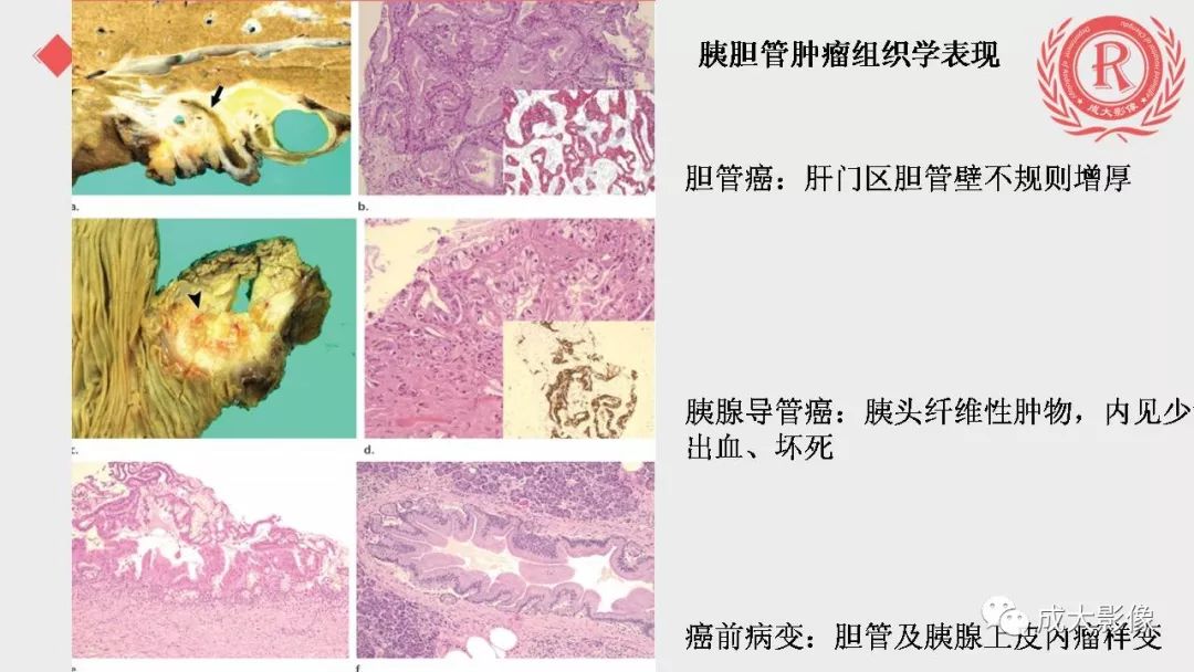 影像PPT - 【PPT】“对应性胆系胰腺疾病”的影像表现-20 影像PPT - 【PPT】“对应性胆系胰腺疾病”的影像表现-20