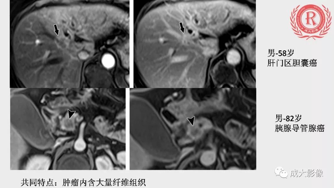影像PPT - 【PPT】“对应性胆系胰腺疾病”的影像表现-21 影像PPT - 【PPT】“对应性胆系胰腺疾病”的影像表现-21