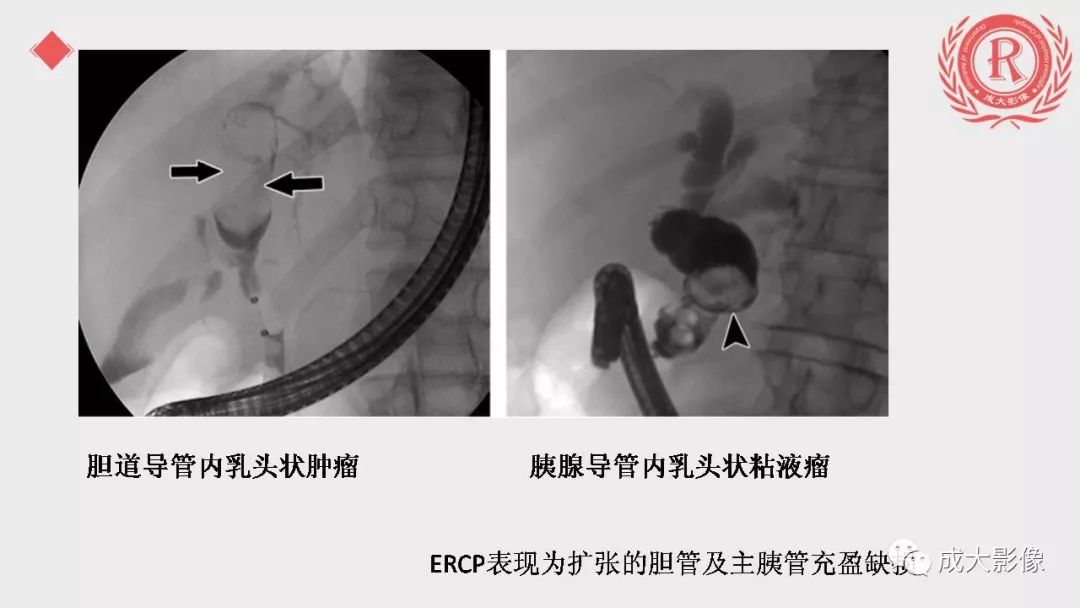 影像PPT - 【PPT】“对应性胆系胰腺疾病”的影像表现-27 影像PPT - 【PPT】“对应性胆系胰腺疾病”的影像表现-27