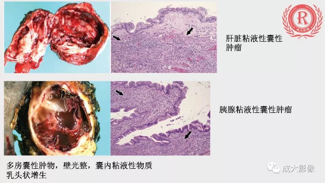 影像PPT - 【PPT】“对应性胆系胰腺疾病”的影像表现-31 影像PPT - 【PPT】“对应性胆系胰腺疾病”的影像表现-31