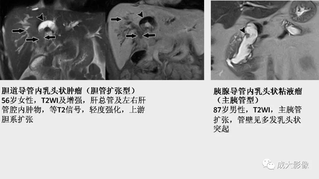 影像PPT - 【PPT】“对应性胆系胰腺疾病”的影像表现-26 影像PPT - 【PPT】“对应性胆系胰腺疾病”的影像表现-26