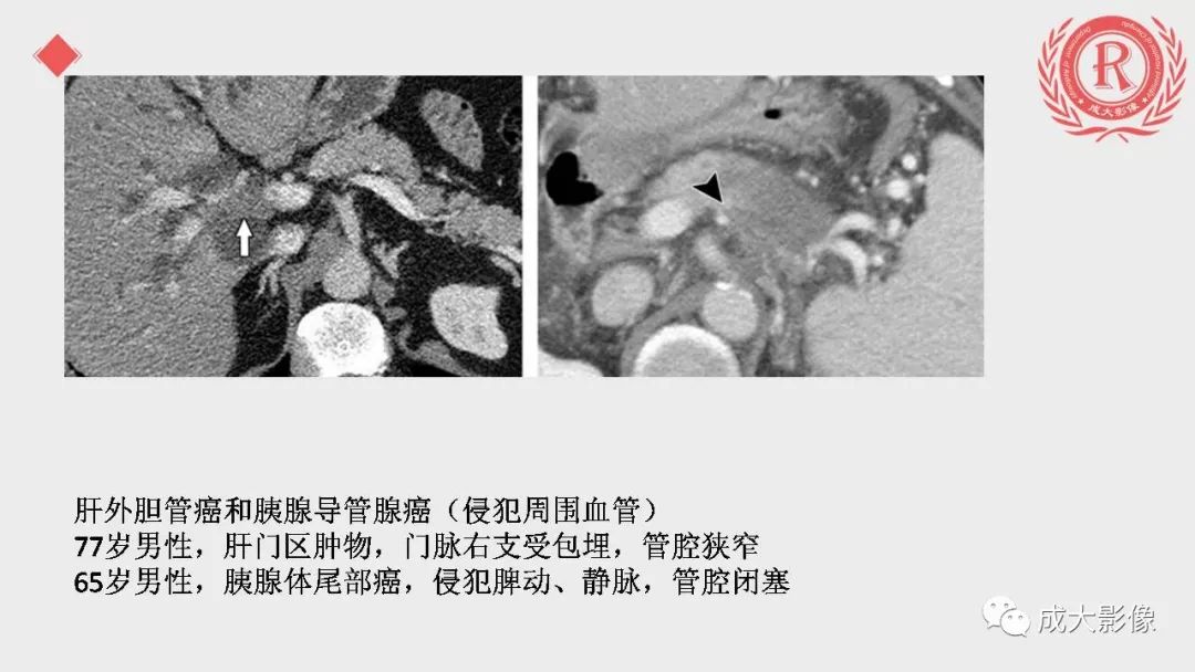 影像PPT - 【PPT】“对应性胆系胰腺疾病”的影像表现-22 影像PPT - 【PPT】“对应性胆系胰腺疾病”的影像表现-22