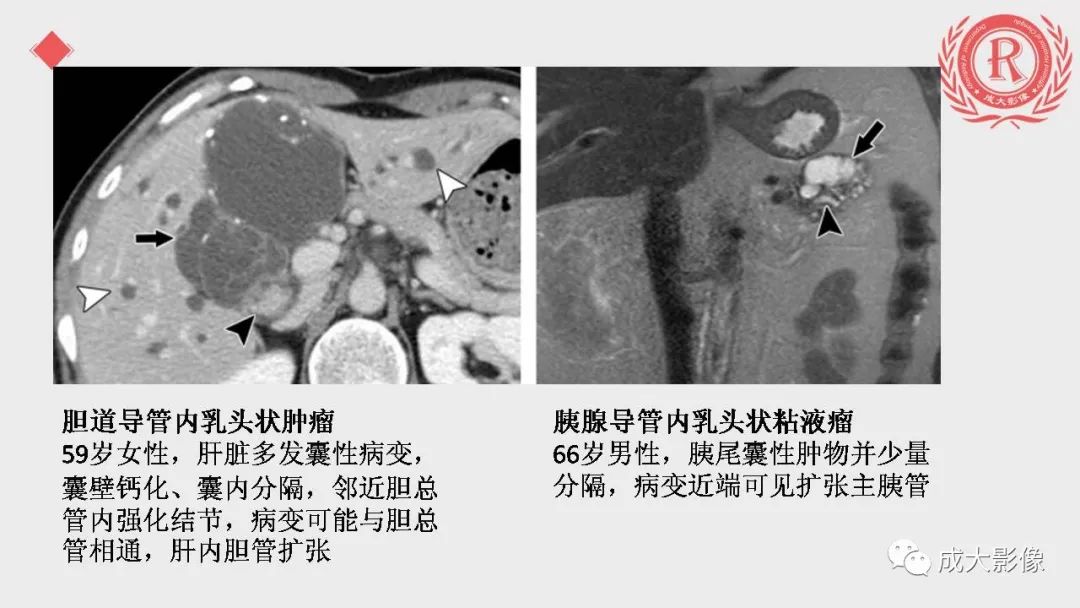 影像PPT - 【PPT】“对应性胆系胰腺疾病”的影像表现-28 影像PPT - 【PPT】“对应性胆系胰腺疾病”的影像表现-28