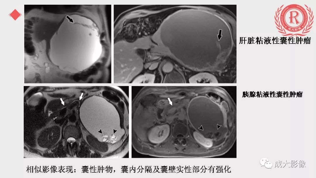影像PPT - 【PPT】“对应性胆系胰腺疾病”的影像表现-32 影像PPT - 【PPT】“对应性胆系胰腺疾病”的影像表现-32
