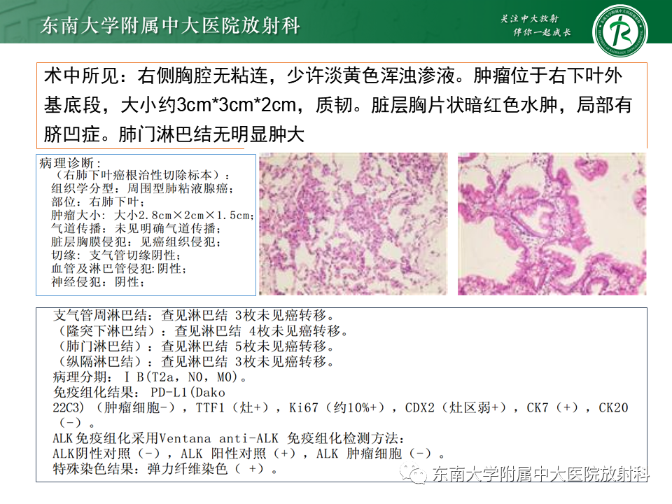 影像PPT - 【PPT】孤立性肺结节影像诊断-5