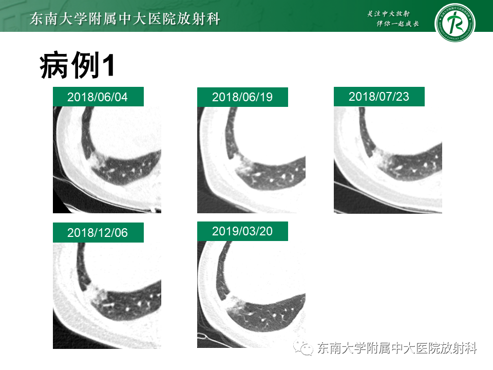 影像PPT - 【PPT】孤立性肺结节影像诊断-3