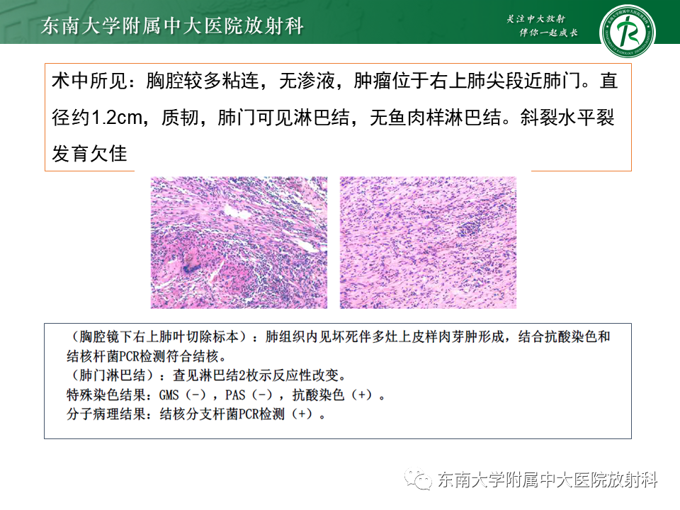 影像PPT - 【PPT】孤立性肺结节影像诊断-8