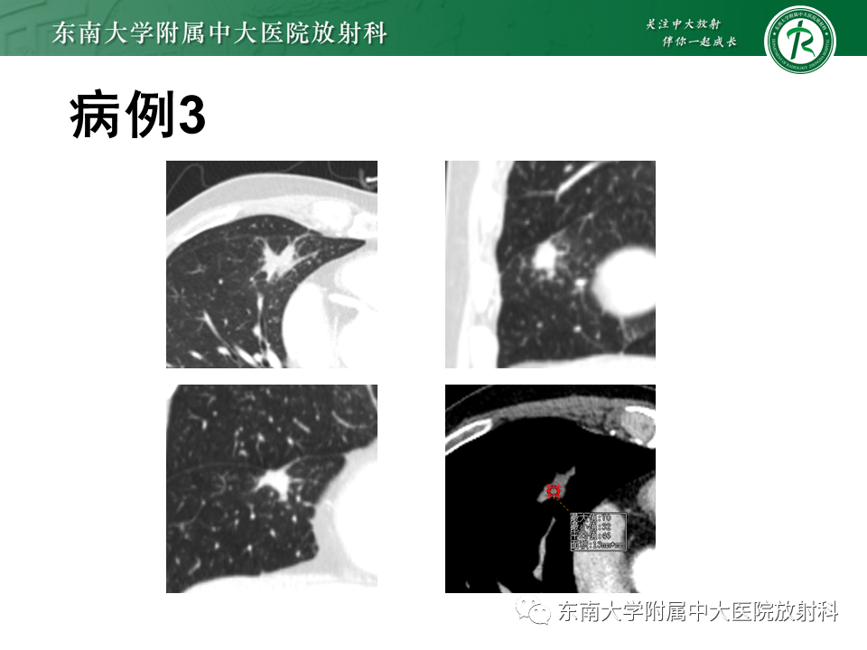 影像PPT - 【PPT】孤立性肺结节影像诊断-10
