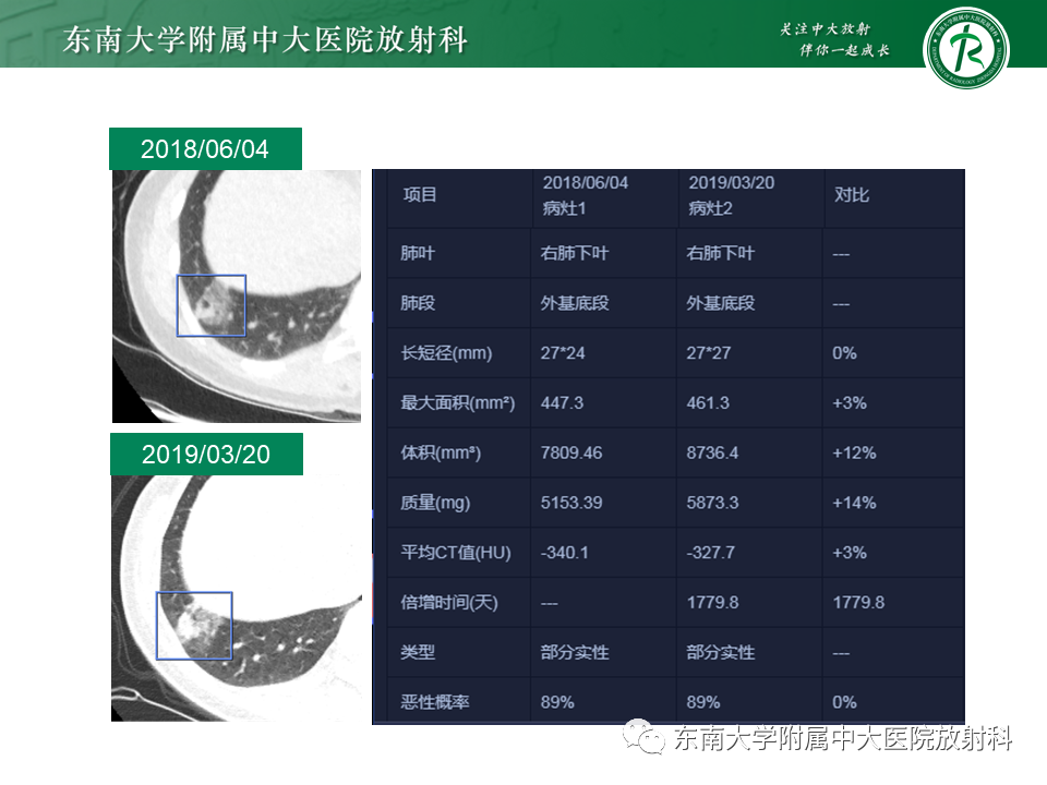影像PPT - 【PPT】孤立性肺结节影像诊断-4