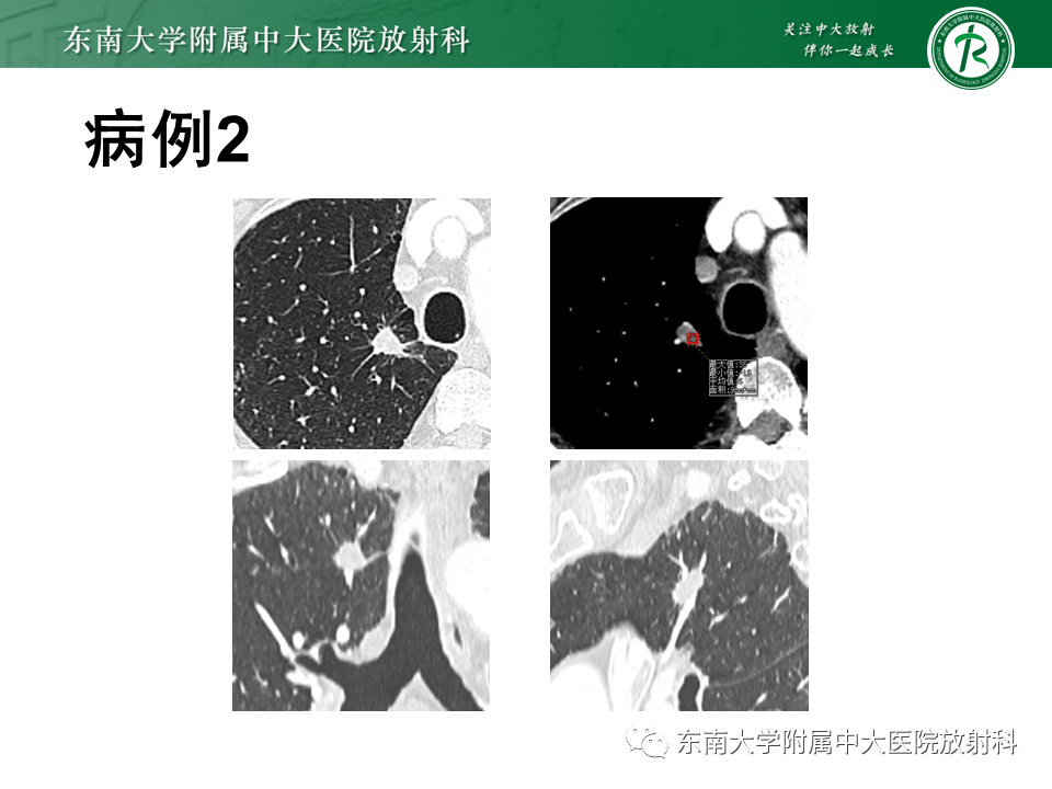 影像PPT - 【PPT】孤立性肺结节影像诊断-7