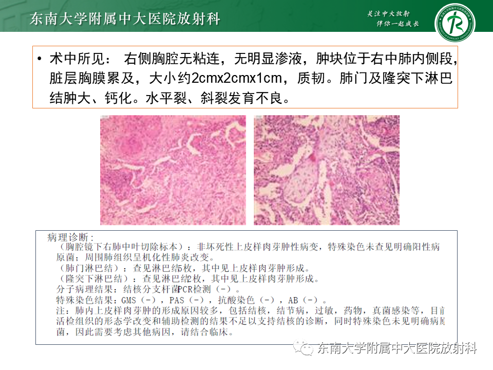 影像PPT - 【PPT】孤立性肺结节影像诊断-11