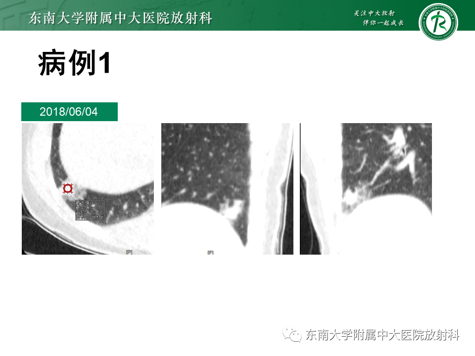 影像PPT - 【PPT】孤立性肺结节影像诊断-2