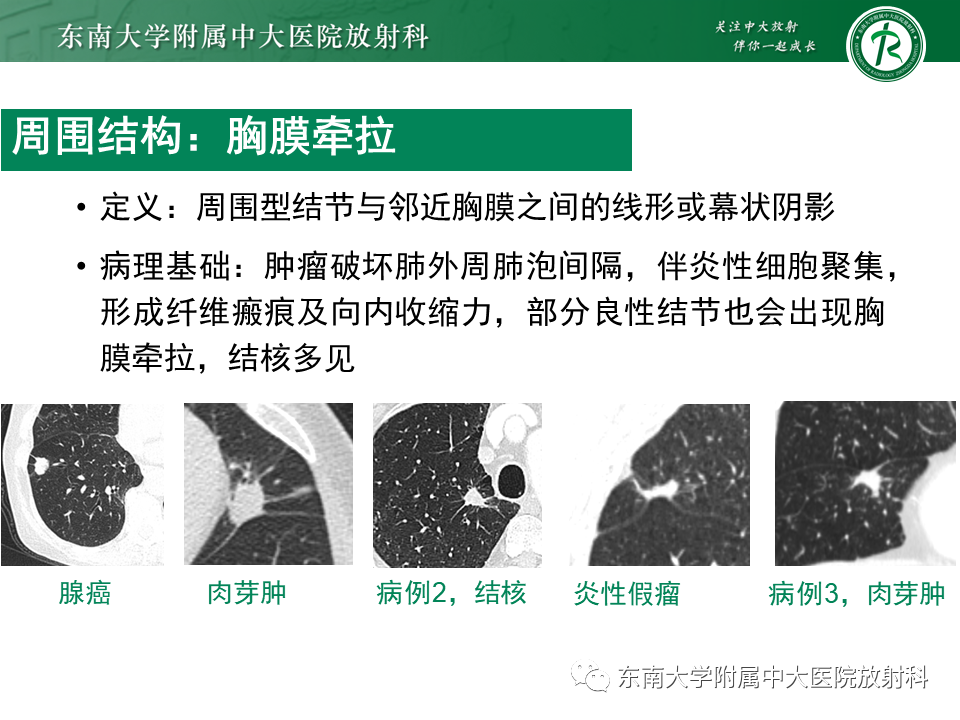 影像PPT - 【PPT】孤立性肺结节影像诊断-28