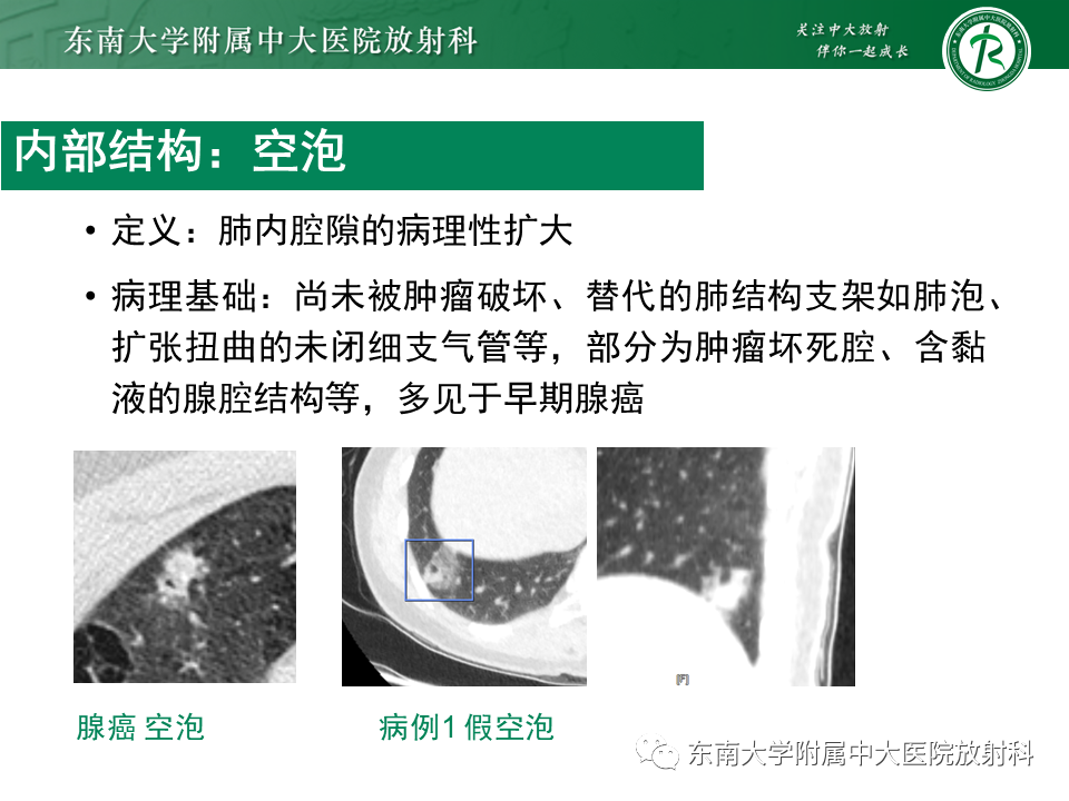 影像PPT - 【PPT】孤立性肺结节影像诊断-20