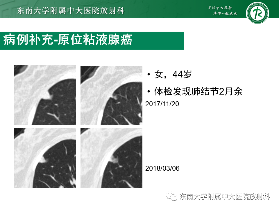 影像PPT - 【PPT】孤立性肺结节影像诊断-36