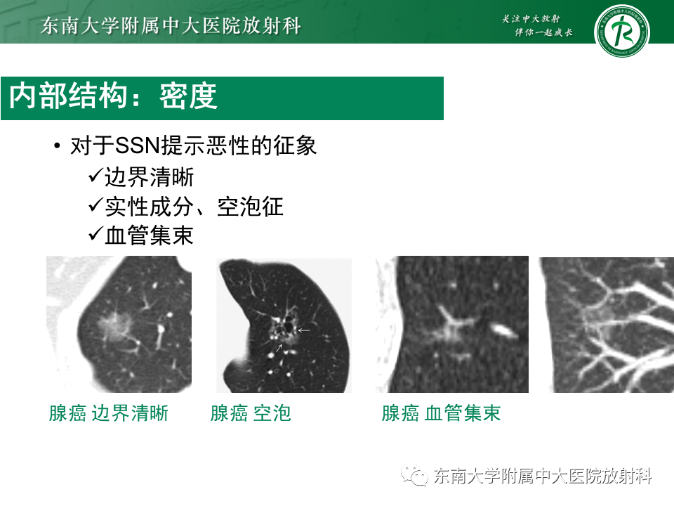 影像PPT - 【PPT】孤立性肺结节影像诊断-19