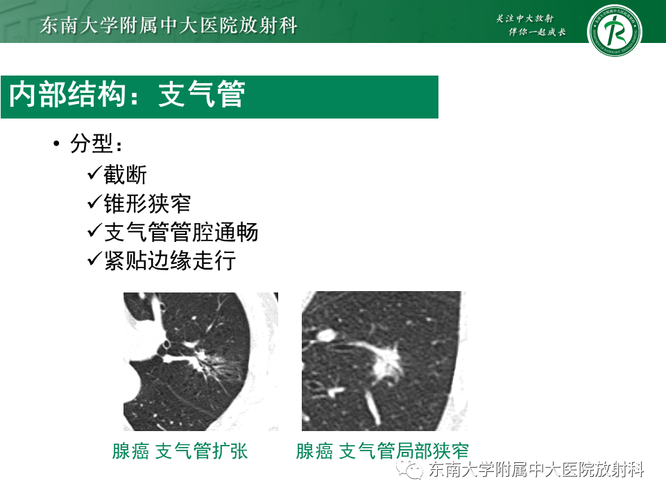 影像PPT - 【PPT】孤立性肺结节影像诊断-23