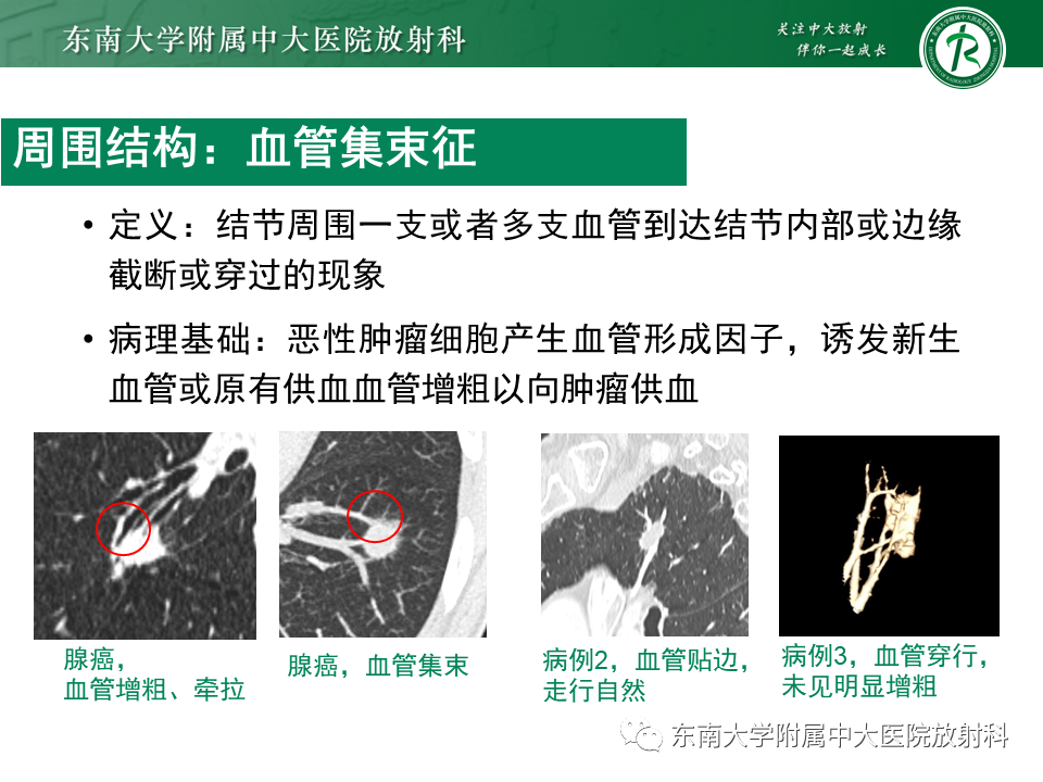 影像PPT - 【PPT】孤立性肺结节影像诊断-27