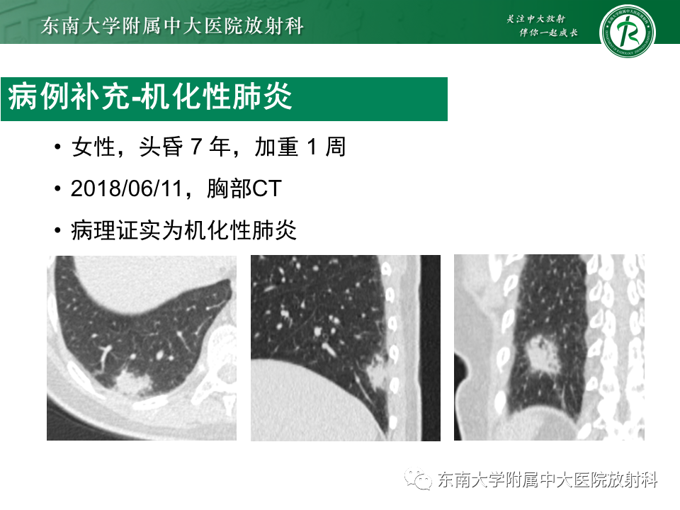 影像PPT - 【PPT】孤立性肺结节影像诊断-37