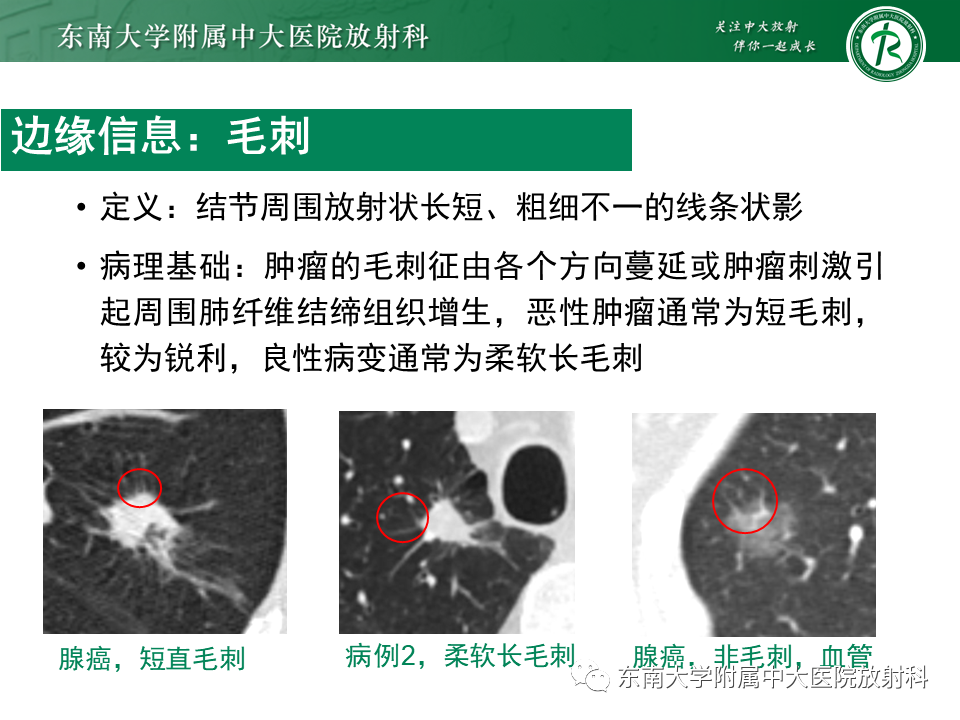 影像PPT - 【PPT】孤立性肺结节影像诊断-25