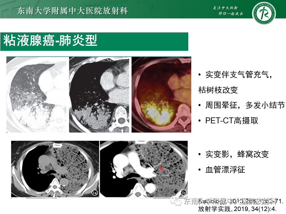 影像PPT - 【PPT】孤立性肺结节影像诊断-35