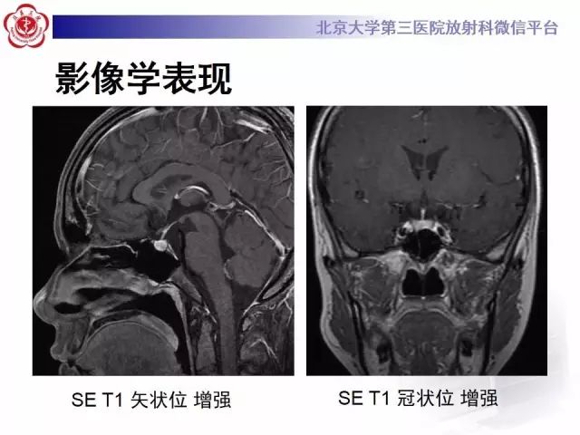 影像PPT - 【PPT】中枢性尿崩症影像诊断-4