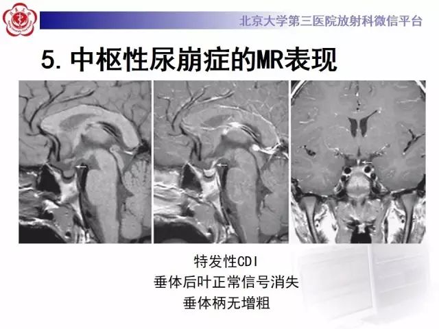 影像PPT - 【PPT】中枢性尿崩症影像诊断-14