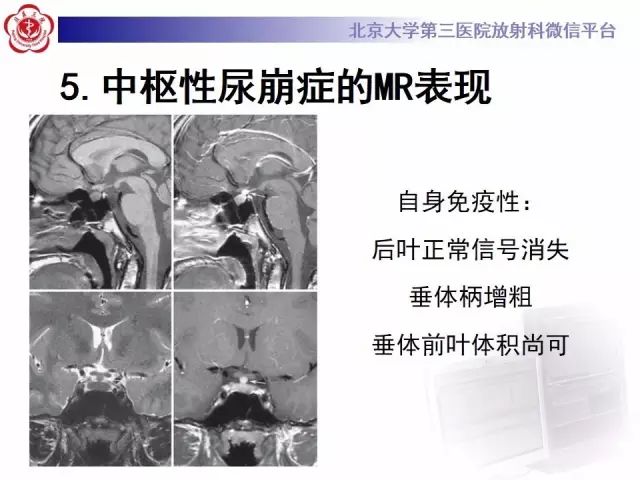影像PPT - 【PPT】中枢性尿崩症影像诊断-15