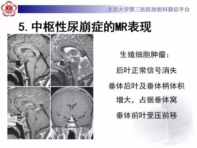 影像PPT - 【PPT】中枢性尿崩症影像诊断-17