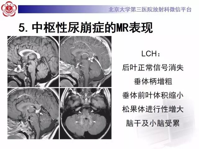 影像PPT - 【PPT】中枢性尿崩症影像诊断-16