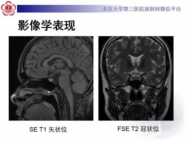 影像PPT - 【PPT】中枢性尿崩症影像诊断-3