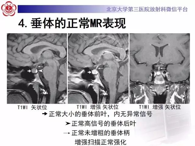影像PPT - 【PPT】中枢性尿崩症影像诊断-12