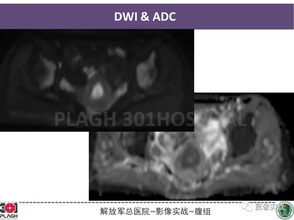 影像PPT - 【病例】子宫内膜息肉1例MR影像-5
