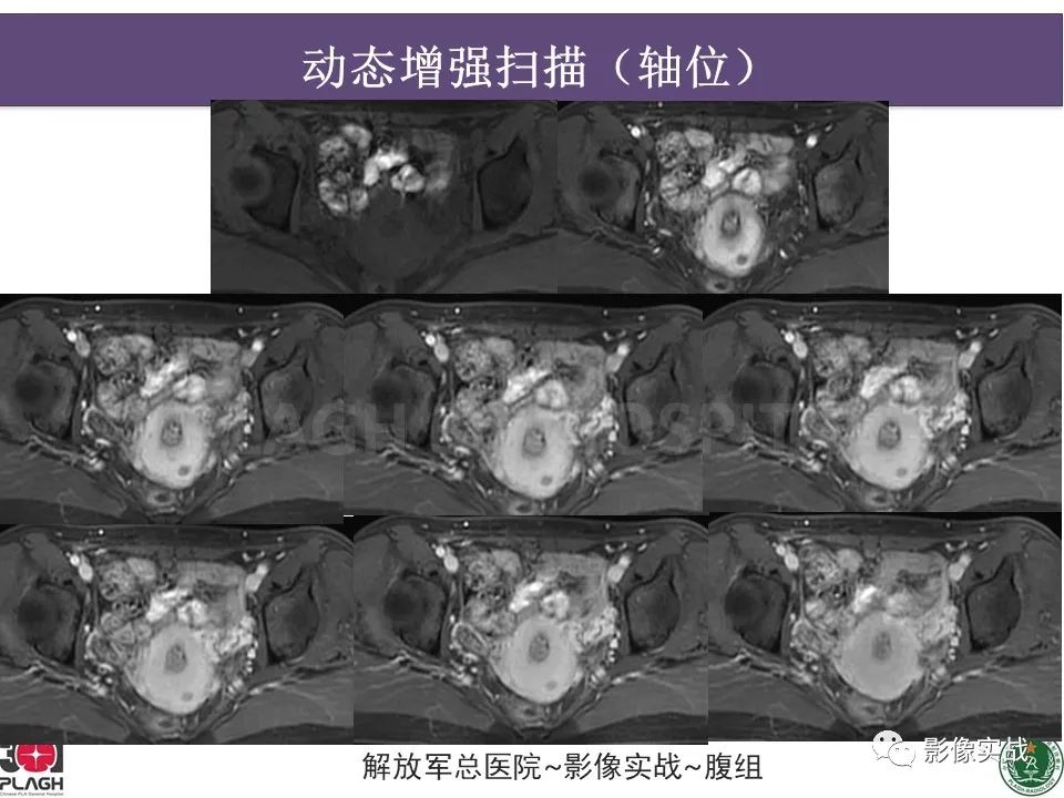 影像PPT - 【病例】子宫内膜息肉1例MR影像-7