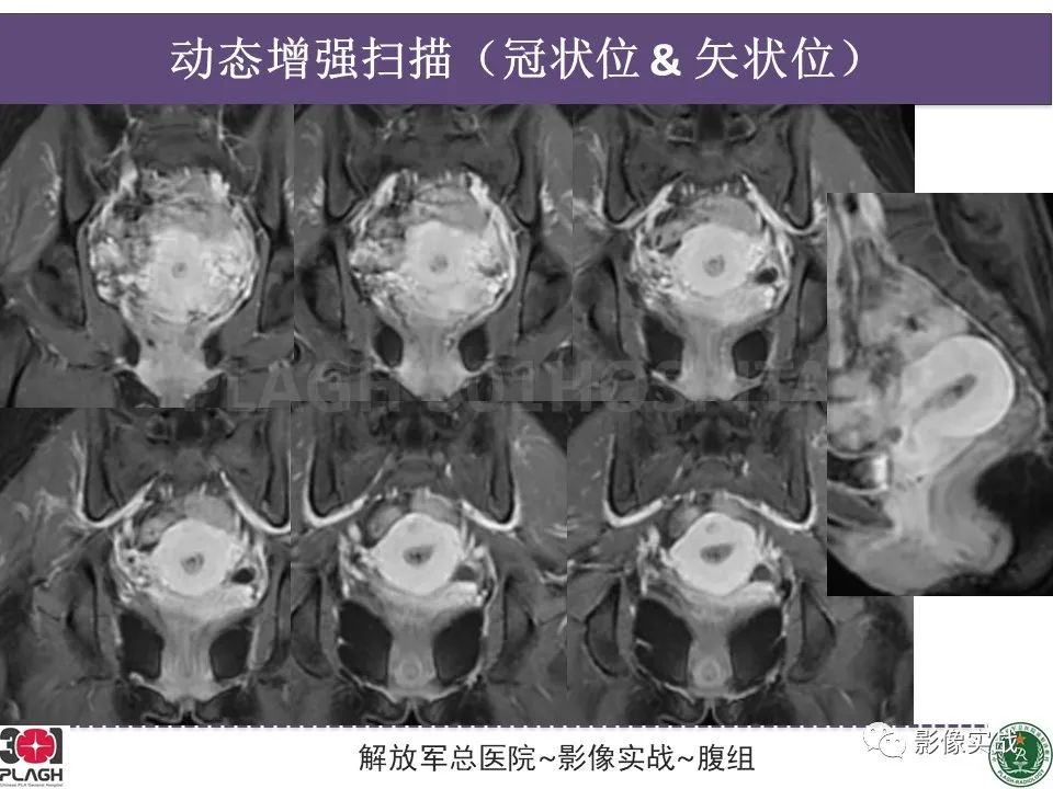 影像PPT - 【病例】子宫内膜息肉1例MR影像-8