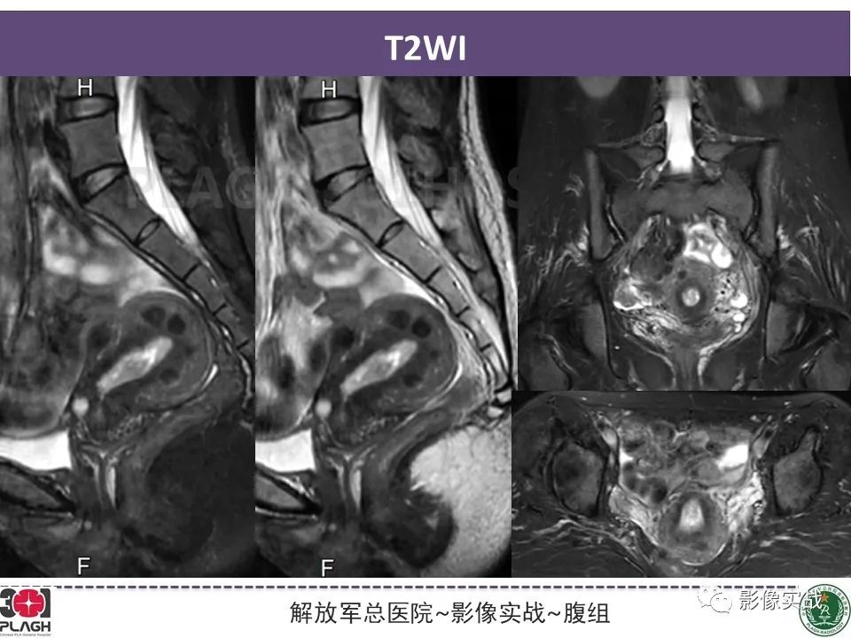 影像PPT - 【病例】子宫内膜息肉1例MR影像-4