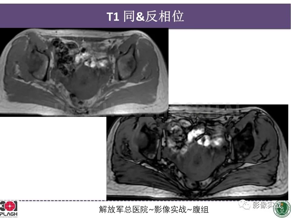 影像PPT - 【病例】子宫内膜息肉1例MR影像-6