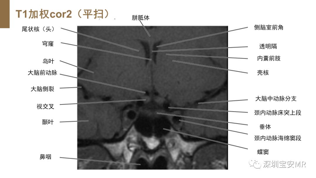 影像PPT - 【PPT】垂体磁共振影像解剖-11