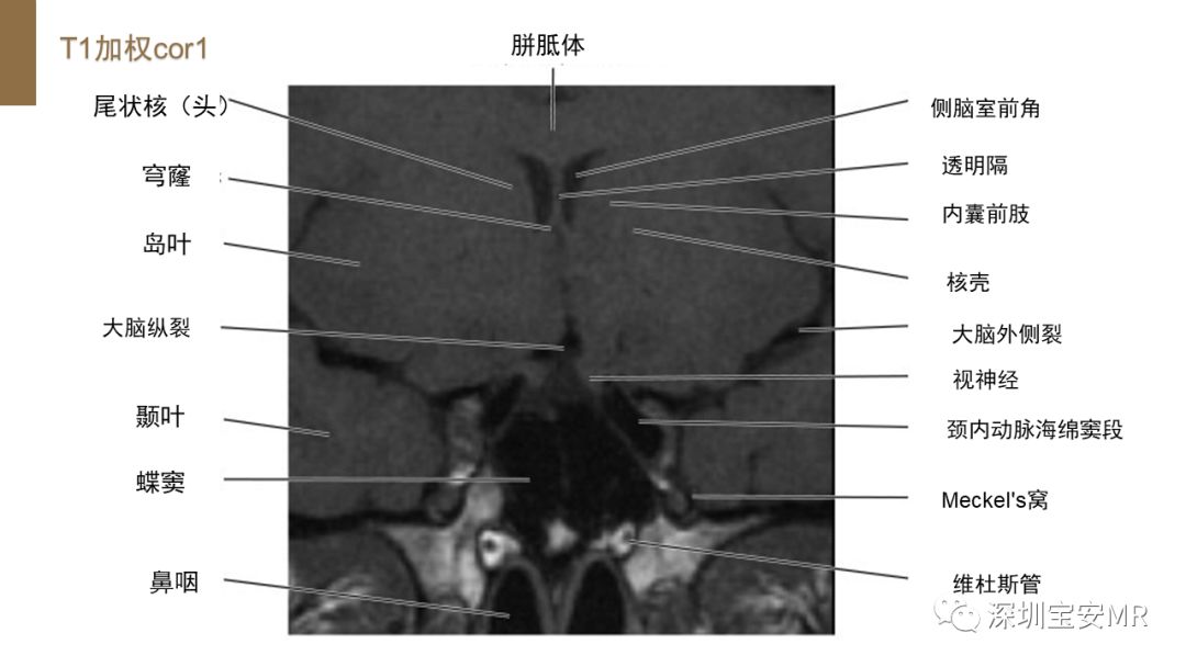 影像PPT - 【PPT】垂体磁共振影像解剖-8
