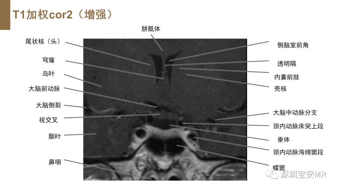 影像PPT - 【PPT】垂体磁共振影像解剖-12