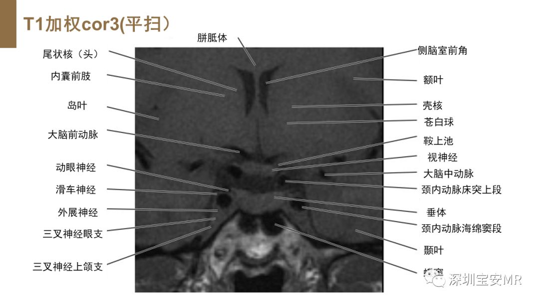 影像PPT - 【PPT】垂体磁共振影像解剖-14