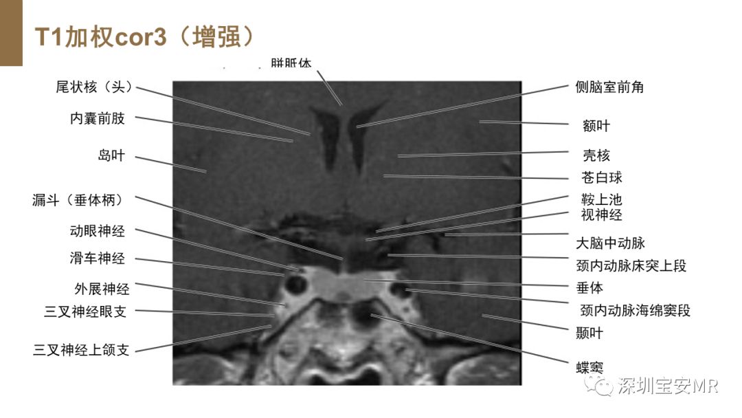 影像PPT - 【PPT】垂体磁共振影像解剖-15