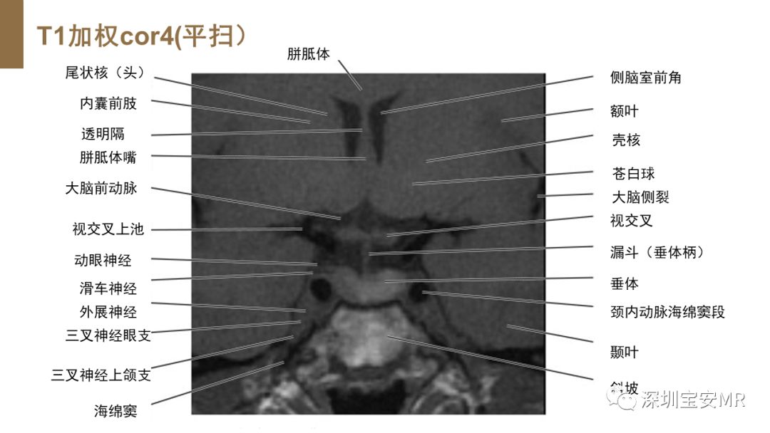 影像PPT - 【PPT】垂体磁共振影像解剖-17