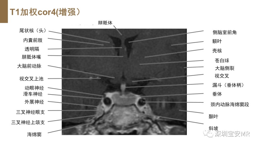 影像PPT - 【PPT】垂体磁共振影像解剖-18