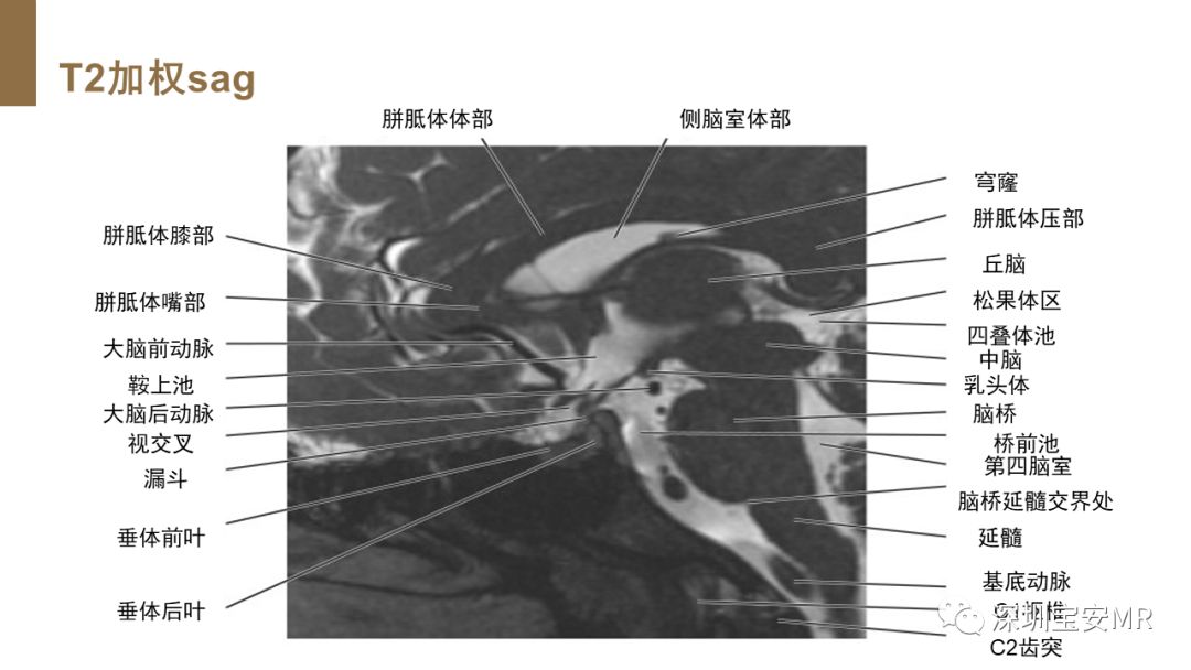 影像PPT - 【PPT】垂体磁共振影像解剖-21
