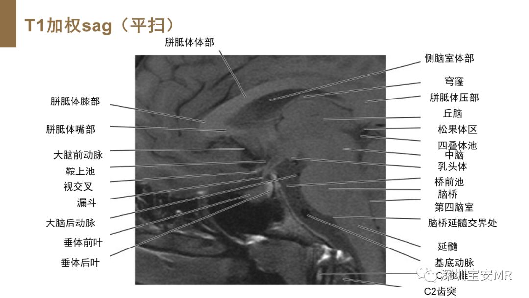 影像PPT - 【PPT】垂体磁共振影像解剖-22